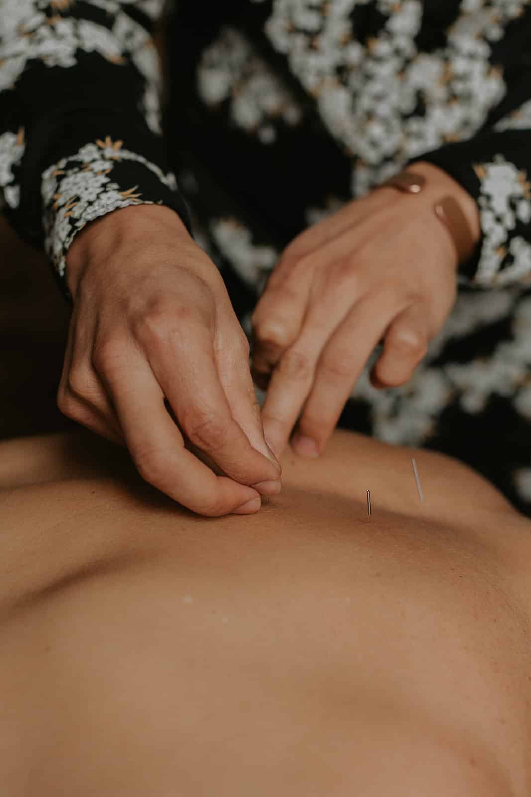 Close-up of acupuncture needles being expertly placed on a patient's skin to enhance fertility, showcasing the precision of the treatment.