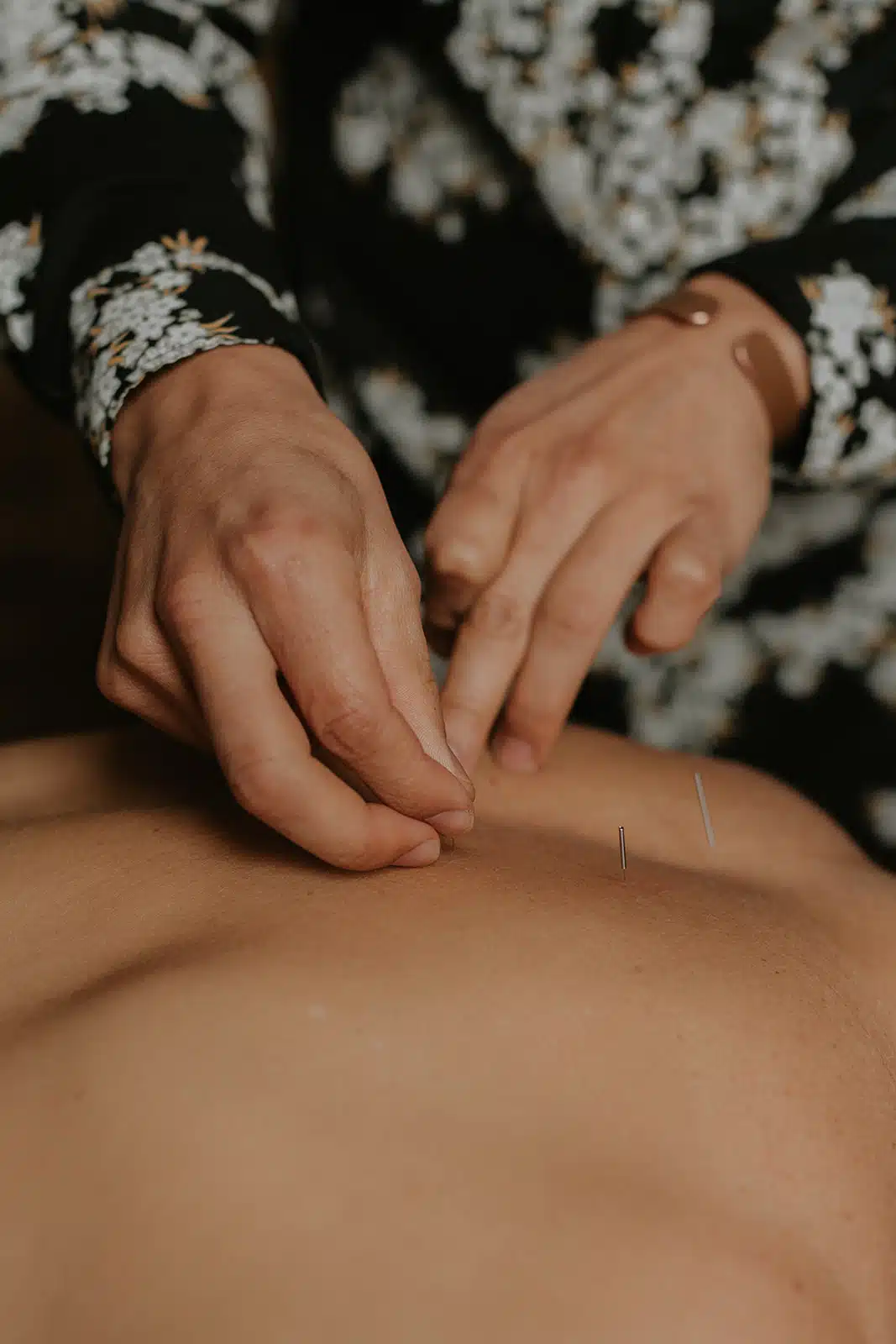 Stomach Acupuncture Therapy in Victoria's Integrative Wellness Clinic Client receiving stomach acupuncture at holistic wellness clinic in Victoria