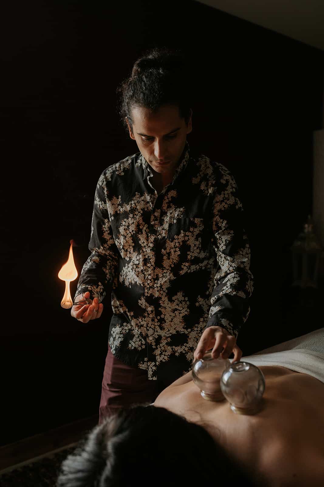 Practitioner lighting a cup for fire cupping therapy in acupuncture